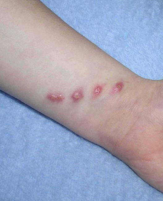 Hives, Skin bumps and Skin rash: Common Related Medical ...