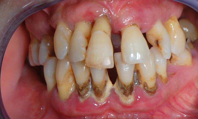 Periodontitis - Inflammation Of Gums - Natural Health News