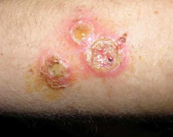 Staphylococcal Infections: MedlinePlus