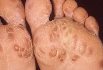 Картинки по запросу arthritis chlamydia