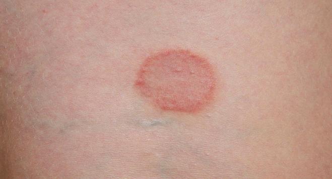 symptoms of ringworm in humans