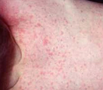 Roseola Rash (Roseola Infantum) – Pictures, Symptoms ...