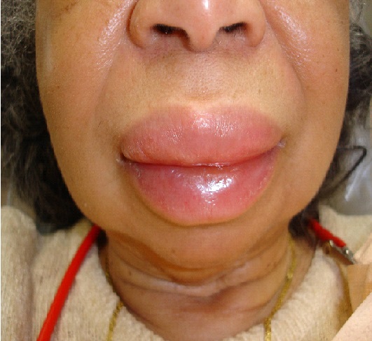 what is angioedema