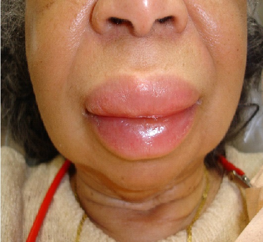 angioedema