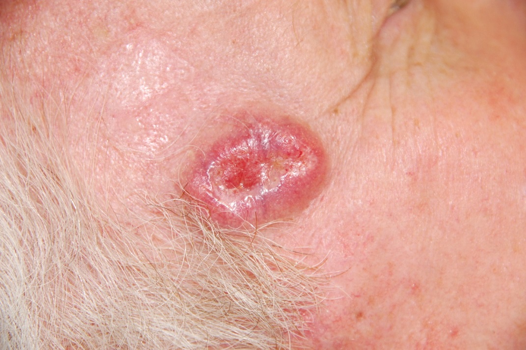 What causes basal carcinoma cancer?