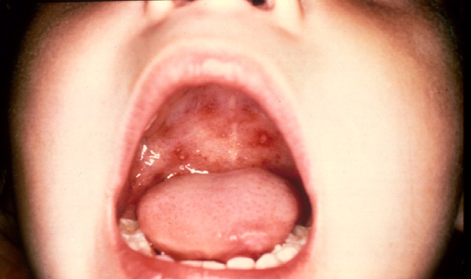 Hand-foot-mouth disease: MedlinePlus Medical Encyclopedia