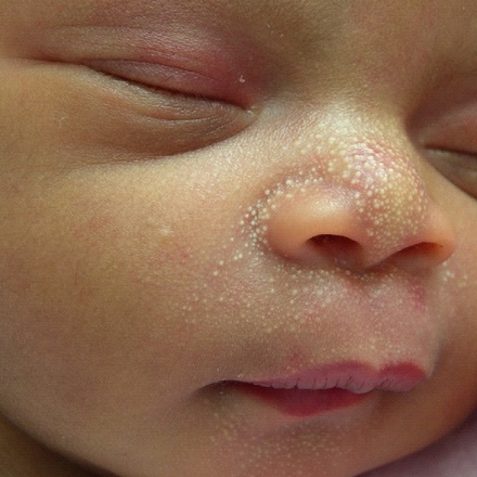 Is It Okay To Use Baby Powder For Heat Rash in Babies?