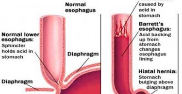 Natural Treatment For Barrett S Esophagus Diet Natural Treatment For Barrett S Esophagus Diet
