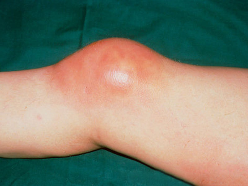 Bursitis Causes, Symptoms, Diagnosis and Treatment Natural Health News