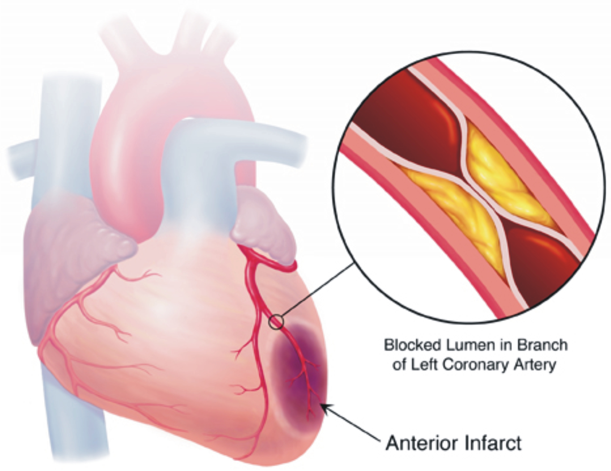 Myocardial Ischemia Causes, Symptoms, Diagnosis and Treatment - Natural