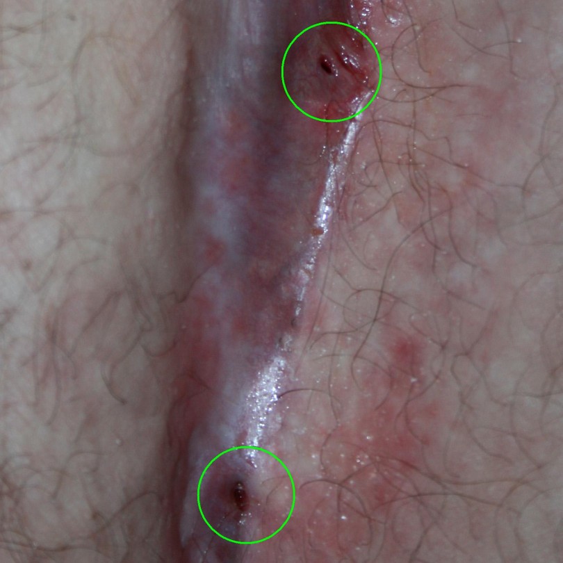 Natural Remedies Anul Cyst Natural Remedies Anul Cyst