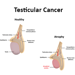 Low testosterone treatment for men