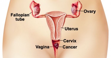 Natural Treatment For Vaginal Cancer Natural Treatment For Vaginal Cancer