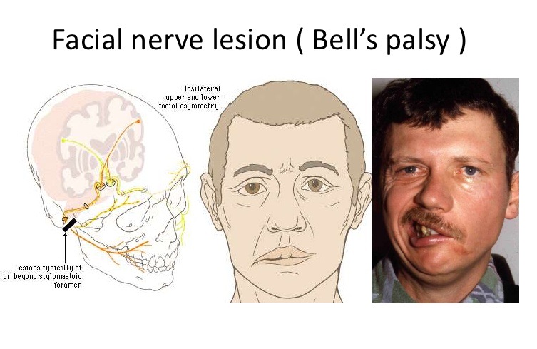 Facial palsy or aging