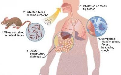 Causes And Symptoms Of Hantavirus Pulmonary Syndrome