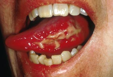 Neutropenia Natural Treatment Neutropenia Natural Treatment