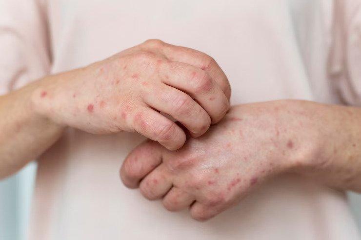 Adult Still’s Disease