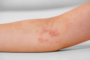 Atopic Dermatitis