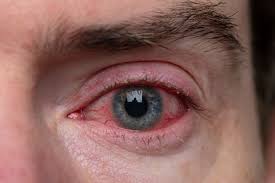 Blepharitis