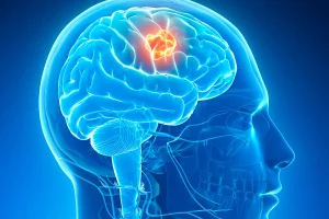 Brain Tumor