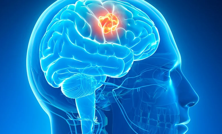 Brain Tumor