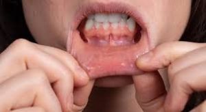 Canker Sores