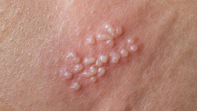 Genital Herpes