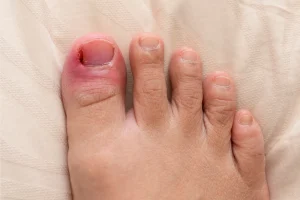 Ingrown Toenails