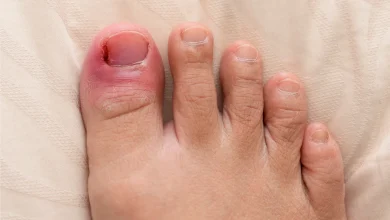 Ingrown Toenails