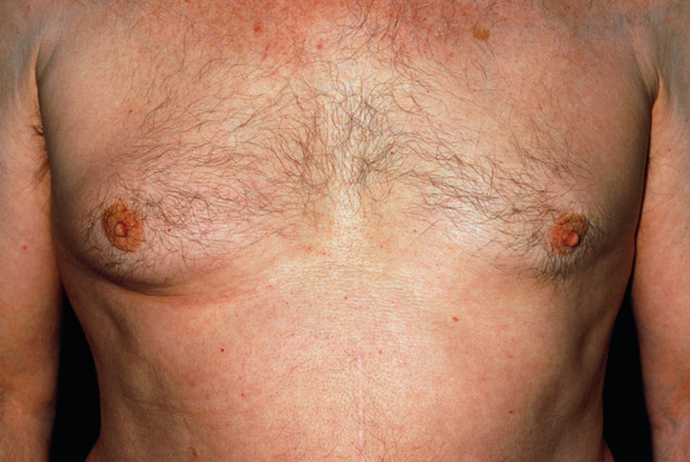 Male Breast Cancer