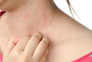 Neurodermatitis