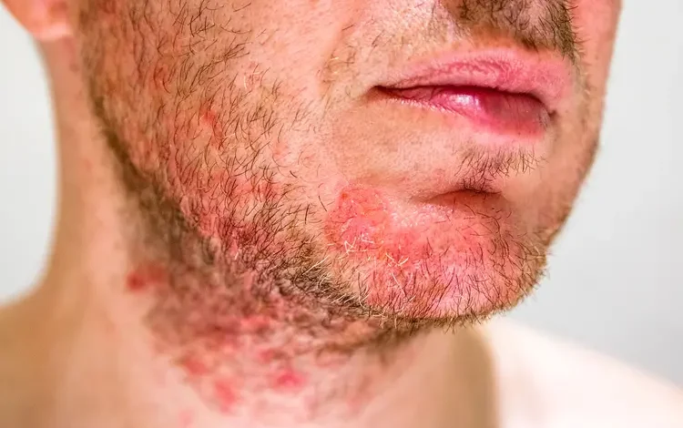 Dermatitis