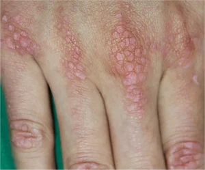 Dermatomyositis