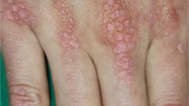 Dermatomyositis