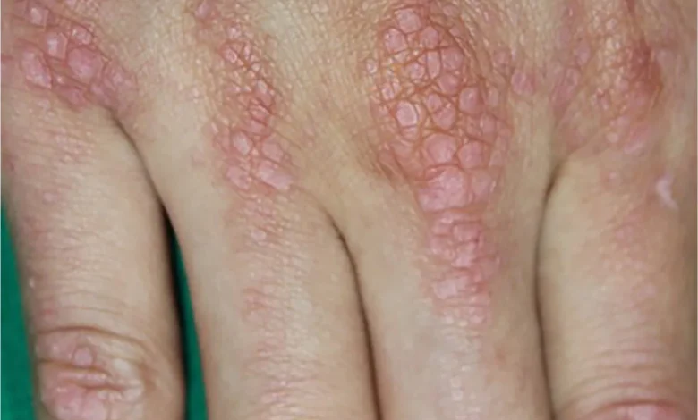 Dermatomyositis