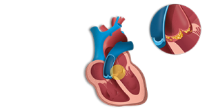 Endocarditis