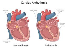 Heart Arrhythmia