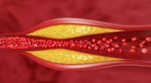 High Cholesterol