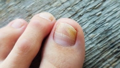 Nail Fungus