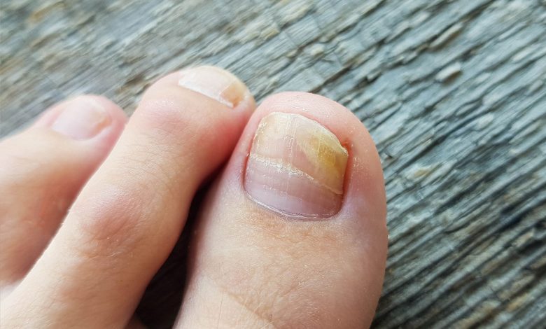 Nail Fungus