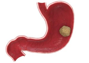 Stomach Cancer
