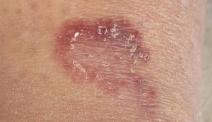 granuloma annulare