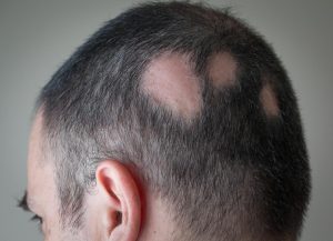 Alopecia Symptoms