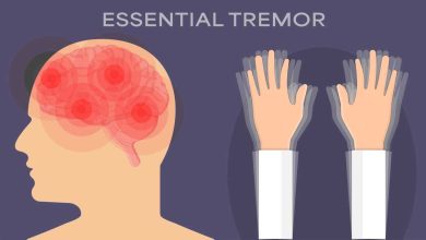 Benign Essential Tremor