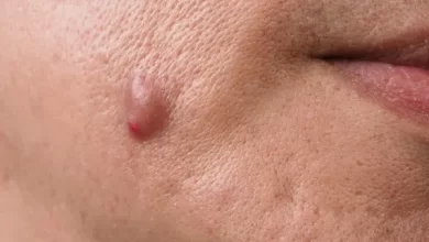Hidradenitis Suppurativa Symptoms