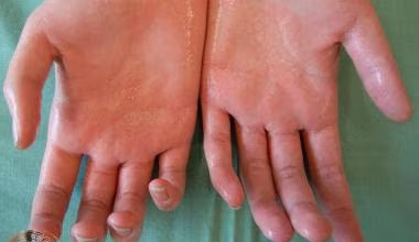 Hyperhidrosis