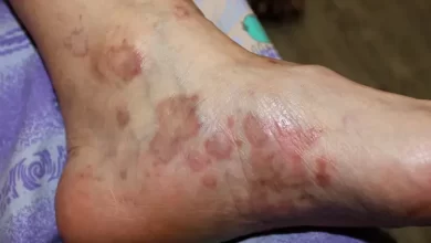 Lichen Planus Symptoms