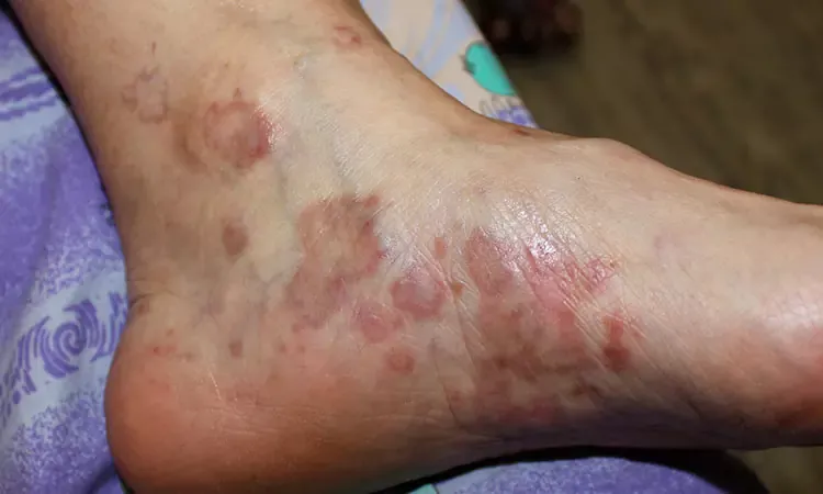 Lichen Planus Symptoms