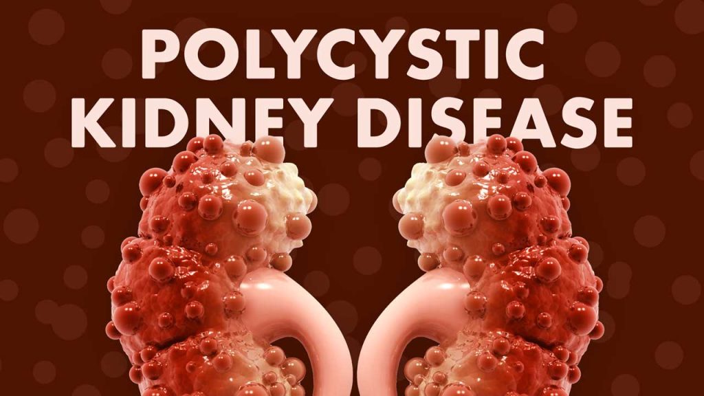 Polycystic Kidney Disease
