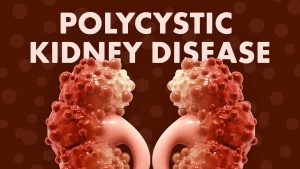 Polycystic Kidney Disease